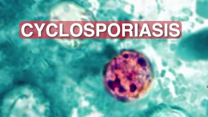 CDC Reports Cyclospora Parasite Stomach Illness Outbreak Across Multiple US States