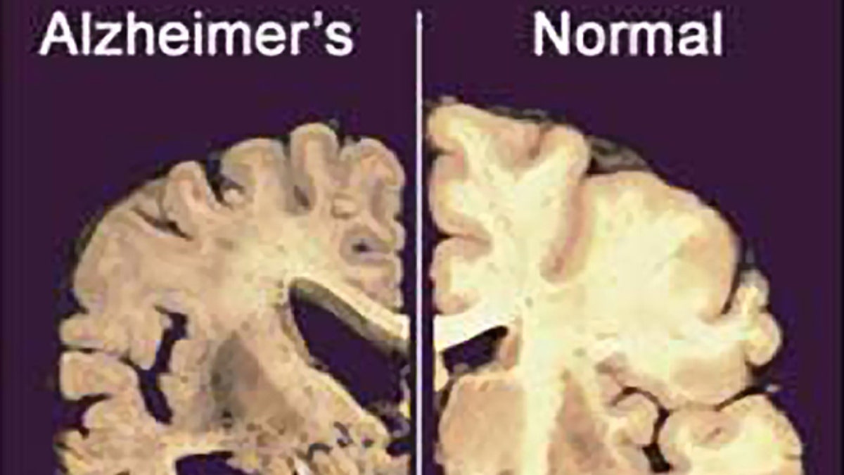 Scientists Reverse Alzheimer's Symptoms in Mice with Breakthrough Nanotechnology