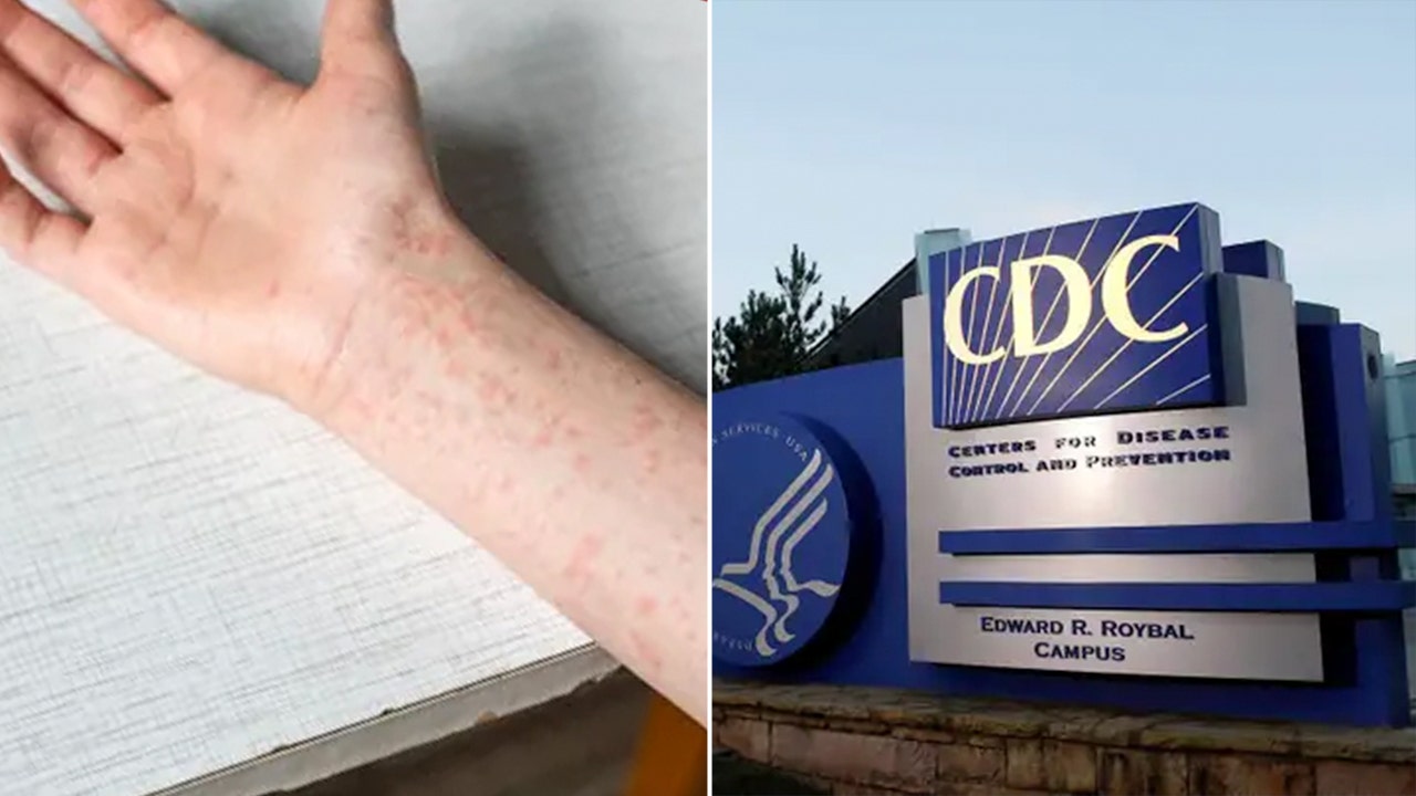 US Measles Cases Reach 2,260 with 34 New Outbreaks in 2026